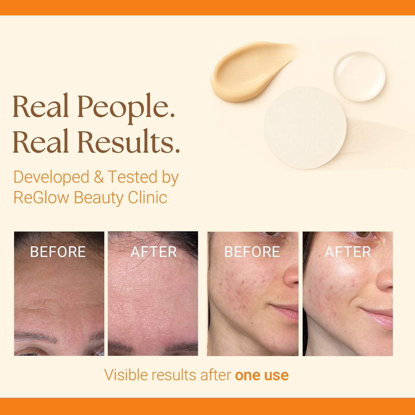 ReGlow Micro Infusion System - Upgraded Stem Cell + Exosomes