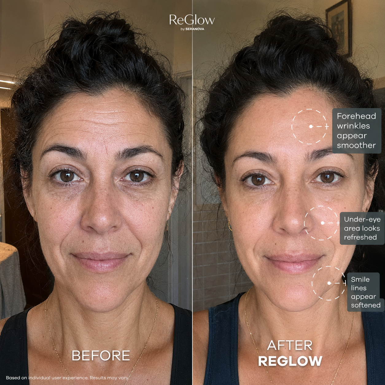 ReGlow Micro Infusion System