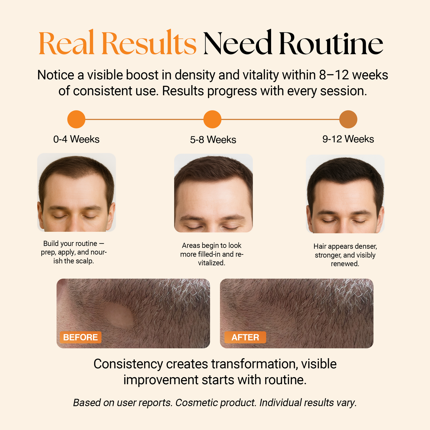 ReGlow Hair Micro-Infusion System