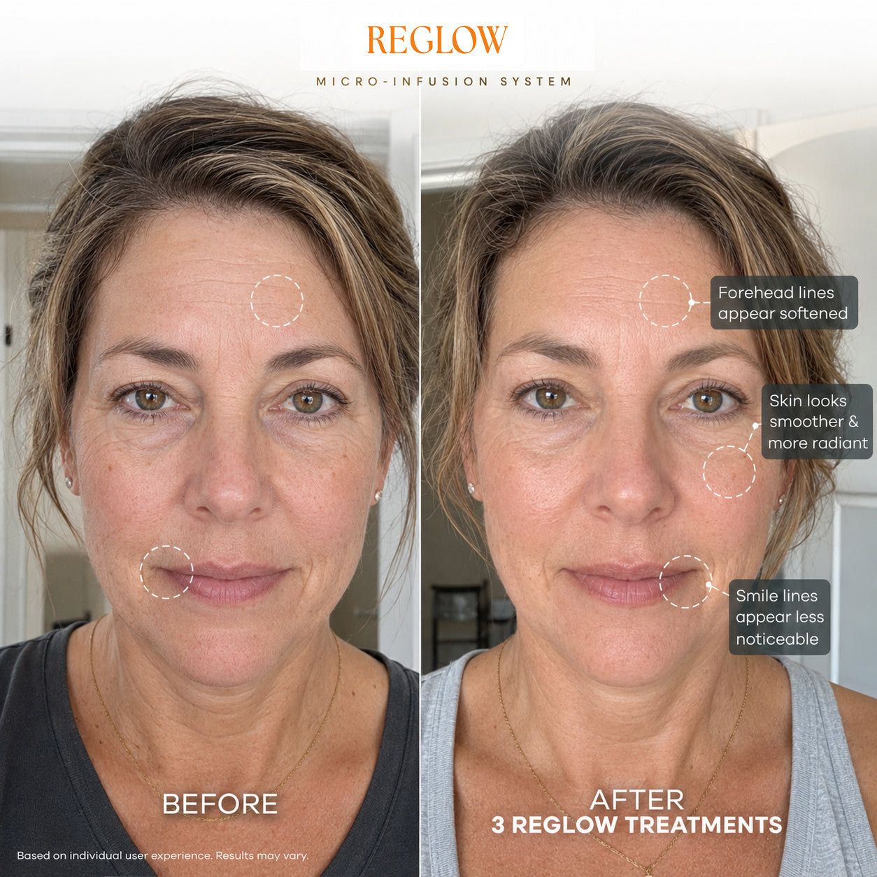 ReGlow Micro Infusion System