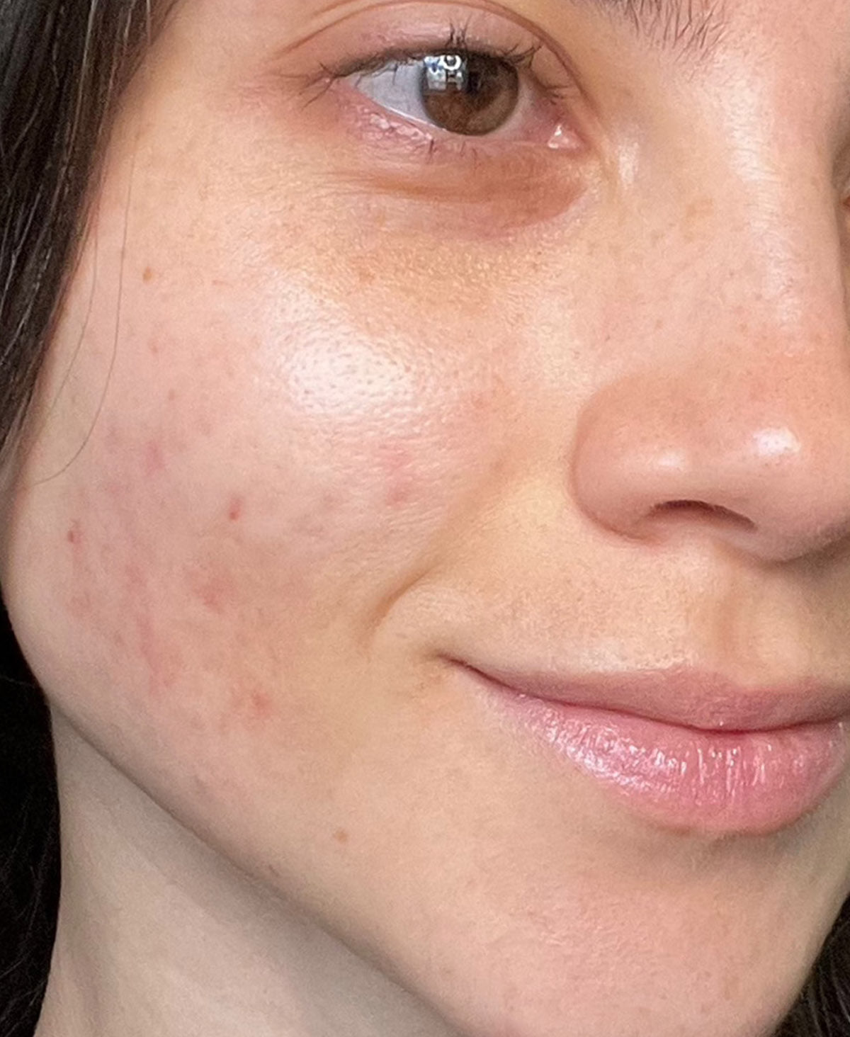 After — cheek texture improved