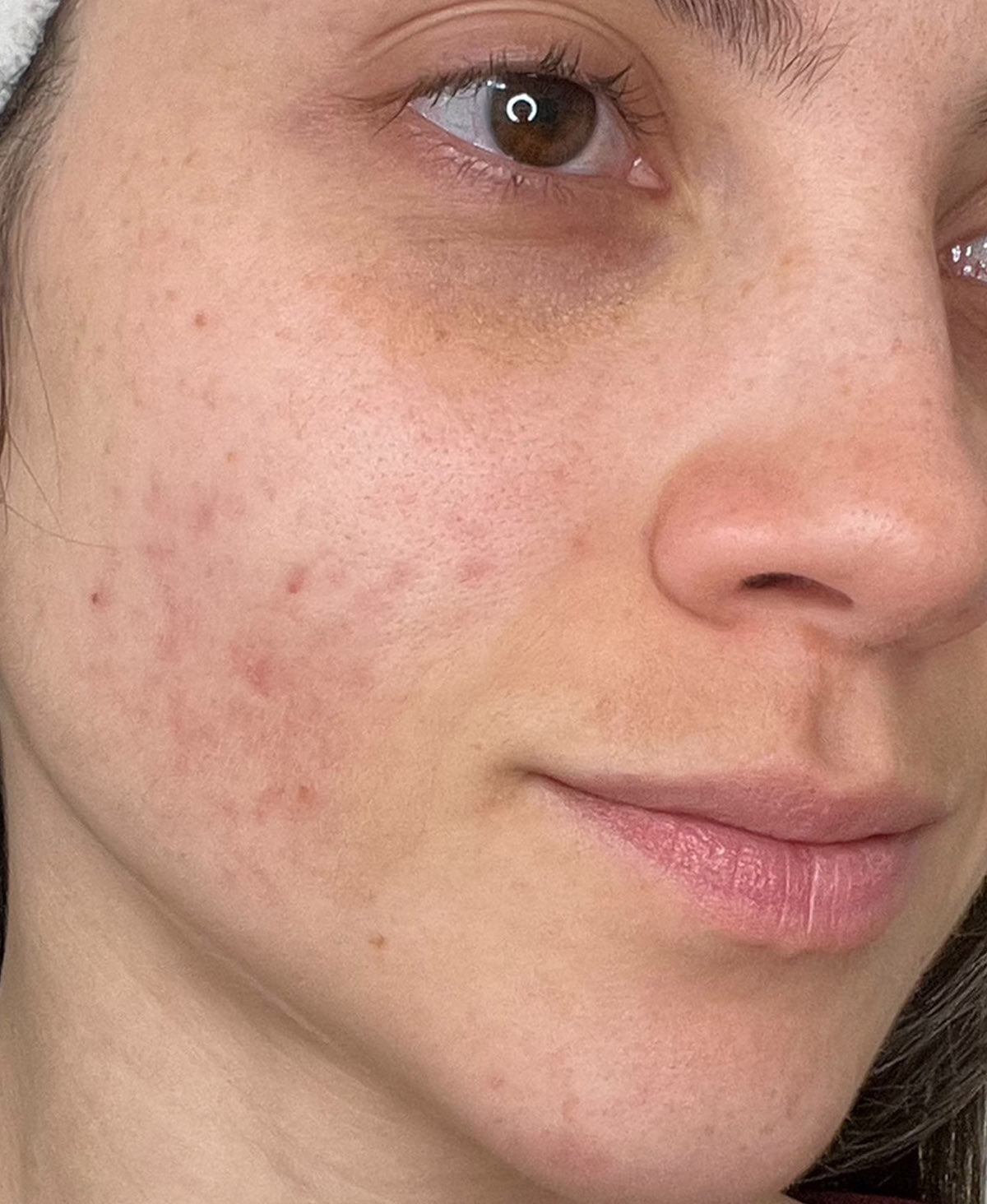 Before — cheek texture