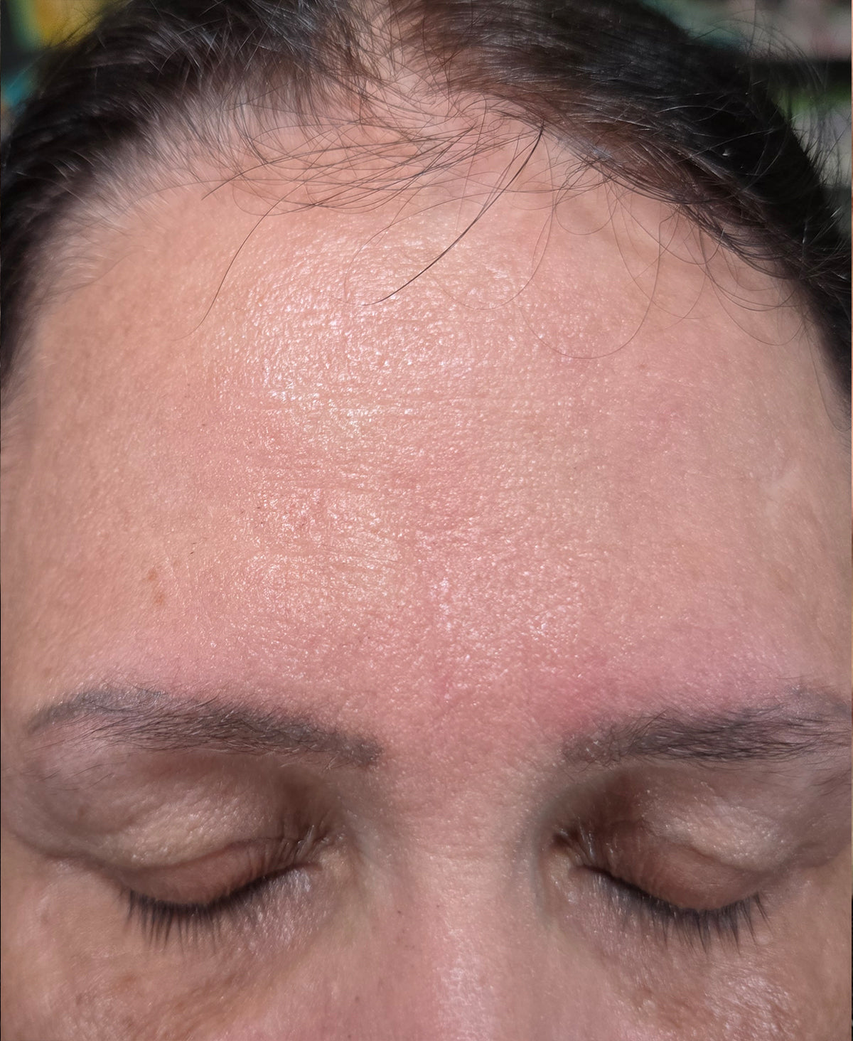 After — forehead lines softened