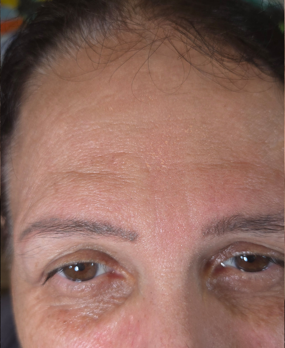 Before — forehead lines