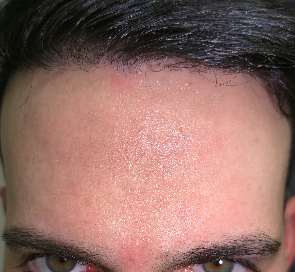 After — forehead texture improved