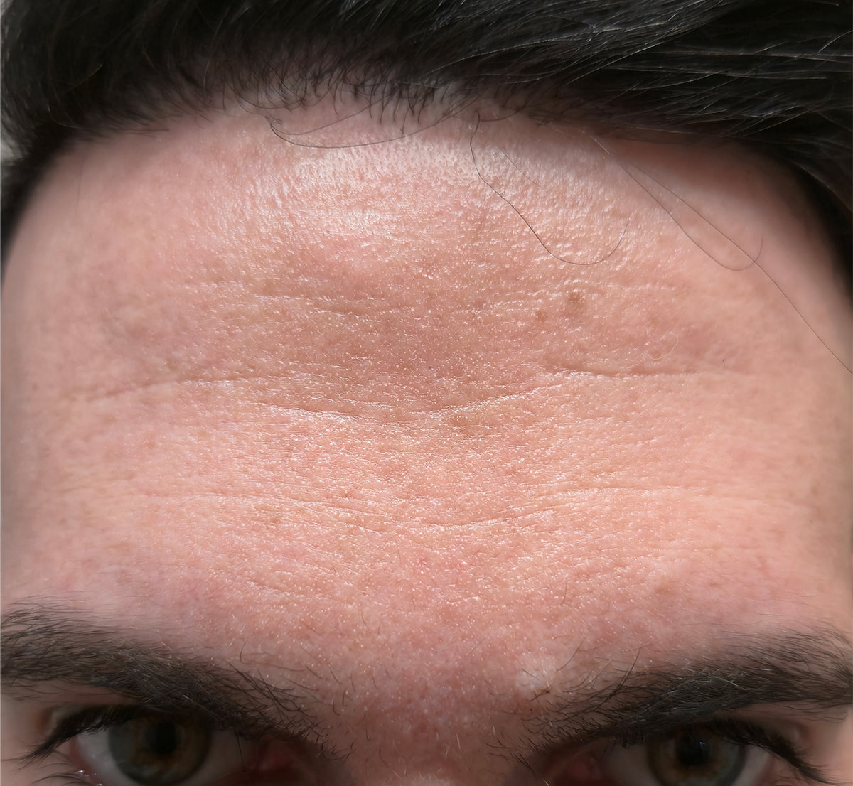 Before — forehead texture